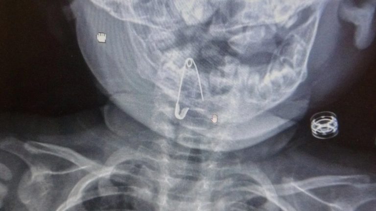 Bitlis’te 8 aylık bebeğin boğazına kaçan çengelli iğne operasyonla çıkartıldı Bitlis’te 8 aylık bebeğin boğazına kaçan çengelli iğne operasyonla çıkartıldı